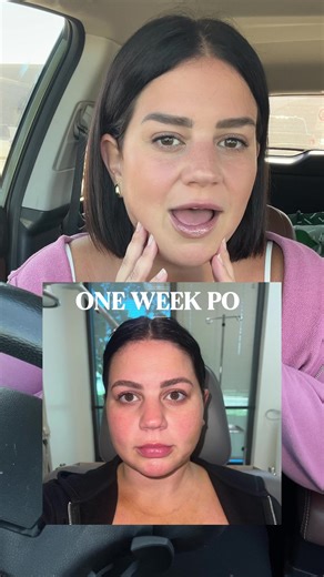 5 Months After Neck Lift: Recovery Journey with Dr. Bassichis