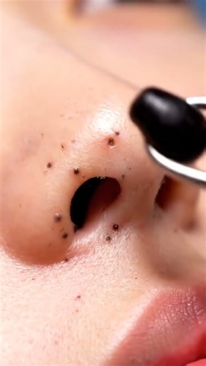 “Satisfying Blackhead Extraction You Can’t Look Away From 😳”