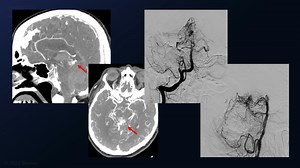 #149: Midline Supracerebellar Infratentorial Approach for a Ruptured Posterior Midbrain Arteriovenous Malformation - Arteriovenous Malformation - Seven Series Collection