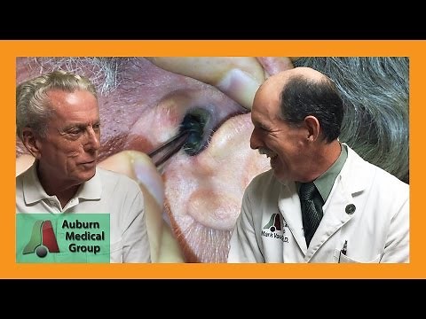 Fastest Stuck Hearing Aid Dome Removal | Auburn Medical Group