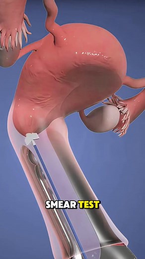 1.2K views | Pap Smear Test / Cervical Cancer Screening 3D Animation #PapSmearTest #CervicalCancerScreening #CervicalHealth #WomensHealth #3DAnimation #MedicalAnimation #HealthAwareness #CancerPrevention #EarlyDetectionSavesLives #Gynecology #WomensCare #HealthEducation #MedicalVideo #PublicHealth #PapTestAwareness | Medical Hub | Facebook