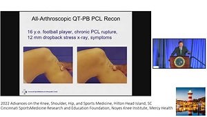 Diagnosis and Treatment of PCL and Posterolateral Ligament Injuries: 2022 Update