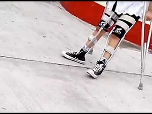 Polio girl walking with braces and crutches.