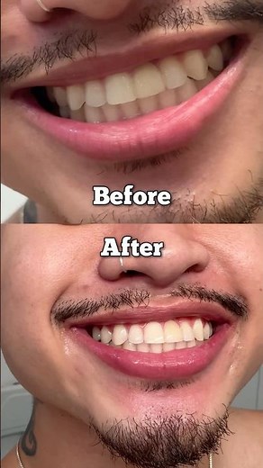 How to whiten your teeth but also treat sensitivity! 🦷