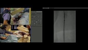 "PRESTO Technique" The Novel Technique to Safely and Precisely Deploy Supera Stent