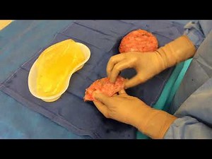 En Bloc removal of ruptured breast implant