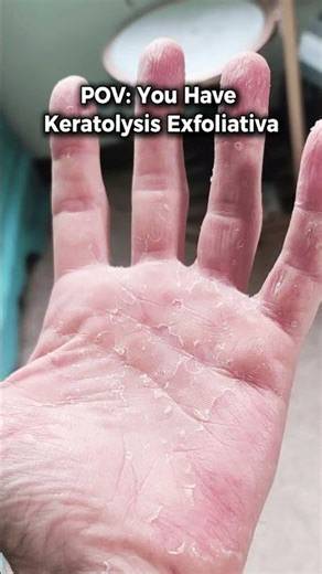 Why Your Skin Is Peeling 😳 (Keratolysis Exfoliativa Explained)