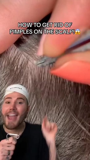HOW TO GET RID OF PIMPLES ON YOUR SCALP!😱 (follow for more!💗) #beauty #skincare #skin #hair | Mama Reaction Fan