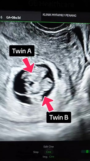 Ultrasound Reveals Developing Twins at 8 Weeks