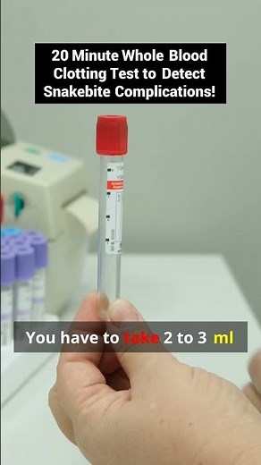 Unveiling the Secrets of the 20-Minute Blood Clotting Test – A Lifesaver in Snakebite Cases!