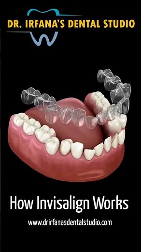 How Invisalign Works | Dr. Irfana's Dental Studio