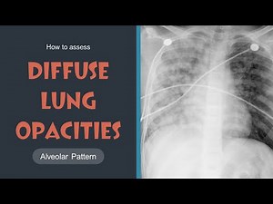 How to assess Diffuse Lung Opacities (Alveolar Pattern) (Lec 14)