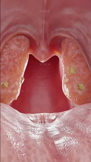 Tonsil stones: what they are and how they form explained in 3D #3danatomy