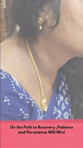 Lichen planus pigmentosus Lpp treatment # Lpp #lpptreatment