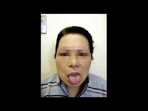 Tongue protrusion dystonia