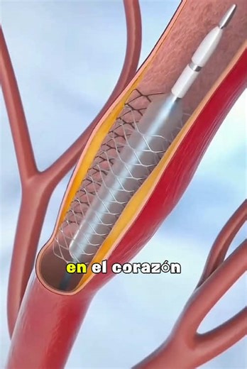 How Stents Restore Blood Flow(3D Animation)#stentangioplasty #angioplasty #heartprocedure #cardiology #blockedarteries