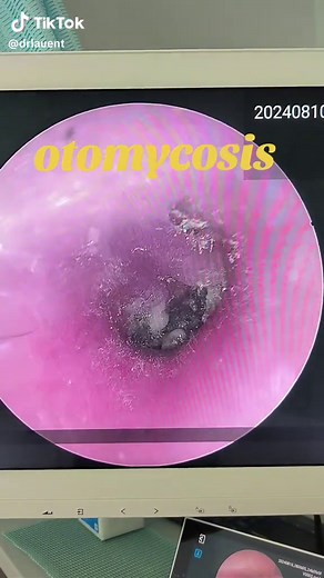 Otomycosis👂 📌is a fungal infection in the ear 📌cause severe ear pain and block 📌treatment is ear suction and anti fungal ear drop If you have severe ear pain kindly consult an ENT doctor🧑‍⚕️