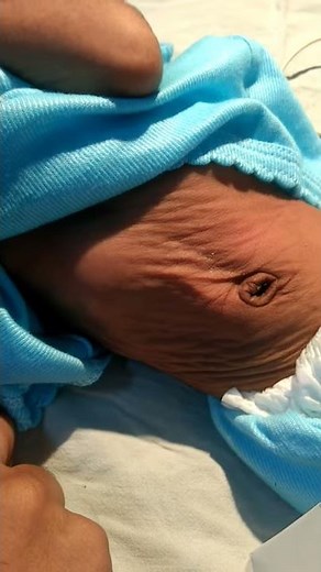 Medical Education Video: Neonatology: Severe dehydration in newborn : poor skin turgor