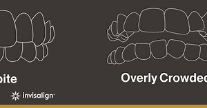 442K views · 18 reactions | From mild to complex, Invisalign® clear aligners work for many teeth-straightening needs. | Invisalign | Facebook