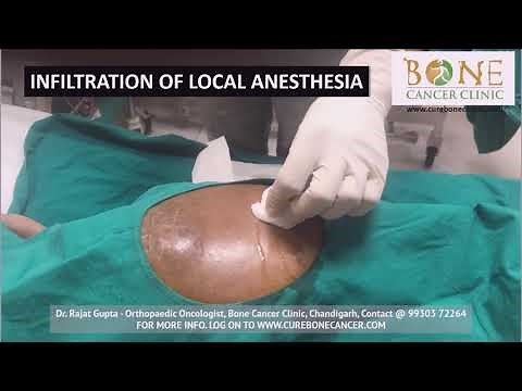 Core Needle Biopsy Technique