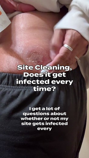 Understanding Site Infections and Care for Remodulin