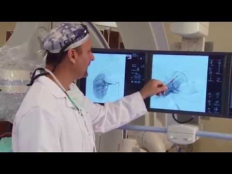Discover Health Episode 8 - Kidney Embolization at Spartanburg Regional Healthcare System