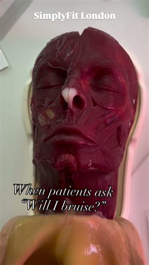 Will I bruise after face treatment?