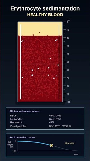 Erythrocyte Sedimentation: Healthy Blood