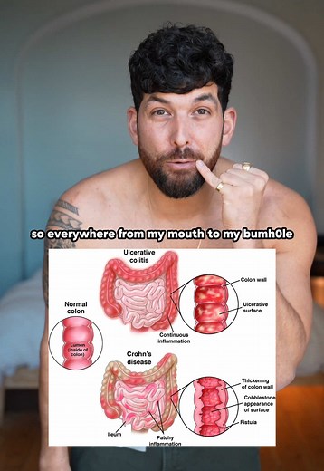 Stoma Explained: Understanding Stomas and Related Conditions