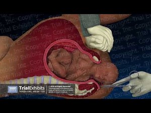 Episiotomy Procedures