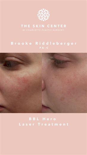 The Skin Center by CPS on Instagram: "Before ➡️ After | 1 BBL Heroic laser treatment Treatment performed by Brooke Riddleberger This before-and-after shows visible improvement in facial veins after just one BBL Heroic laser treatment. BBL Heroic uses targeted light energy to address unwanted facial redness and visible veins, helping create a clearer, more even-looking complexion. By treating vascular concerns at the source, BBL Heroic can improve overall skin tone and reduce the appearance of fa