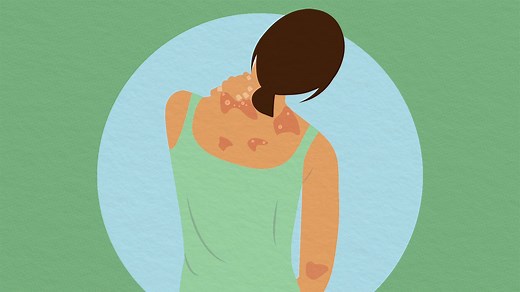 Psoriasis: Managing Skin Cracks and Bleeding