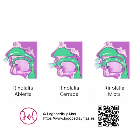 ¿Qué es la RINOLALIA? 🥇 | SÍNTOMAS Y TRATAMIENTO