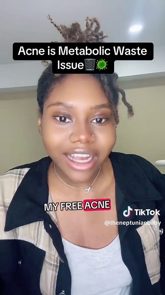Acne is metabolic waste in the body…. It’s not a topical issues | acne