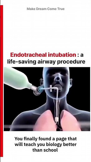 🫁 Endotracheal intubation 🩺 a life-saving airway procedure 💨 | MDCT