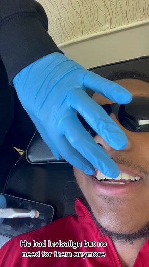 Composite Veneers for a Perfect Smile: My Brother's Transformation