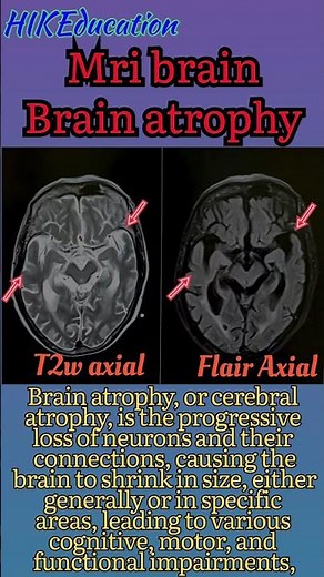 Mri brain / brain atrophy / cerebral atrophy / head