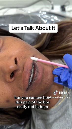 Lip Tattoo Neutralization Procedure: What You Need to Know
