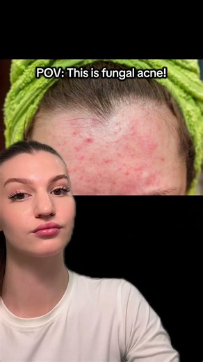 Fungal acne causes clusters of small, itchy, red bumps on your skin.#fungalacne #foreheadbumps #acne