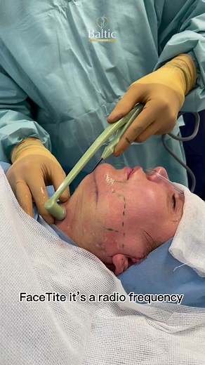 𝐅𝐚𝐜𝐞𝐓𝐢𝐭𝐞 💥✅ WHAT IS FACETITE ?FaceTite is the next best thing to a traditional facelift, without the associated large scars and downtime of excisional surgery.It is a minimally invasive procedure designed to remodel skin and treat fat.✅ WHAT AREAS CAN BE TREATED ? All facial and neck areas can be treated with FaceTite. This includes double chins, jowls, periorbital zones, nasolabial folds, and other smaller body areas requiring contouring.❗️Please send us a private message or email to:�