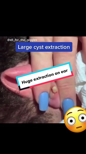 Huge cyst wxtraction from ear! #cystpopping #cystexplosion #whiteheadpimples #blackheadpimple #extractionsatisfaciton #pimplepop