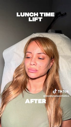 PDO Thread Lift Solutions for an Instant Lift