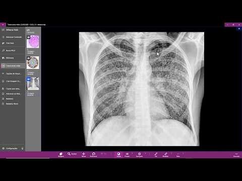 Tuberculose miliar