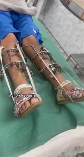 Achondroplasia Lengthening and Varus Deformity Limb Treatment