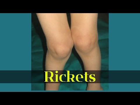 Understanding Rickets in Children: A Quick Guide for Parents