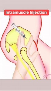 A wrong intramuscular (IM) injection can, in rare but serious cases, lead to paralysis or nerve damage. Here's a breakdown of how this can happen: 1. Nerve Injury Injecting into or too close to a major nerve — particularly: Sciatic nerve in the buttock (gluteal region) Radial nerve in the deltoid region Femoral or lateral femoral cutaneous nerves in the thigh Result: Immediate sharp pain, weakness, numbness, or even long-term paralysis in the affected area. 2. Incorrect Site Selection Using the 