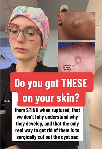 Understanding Cysts: Causes, Effects, and Treatments