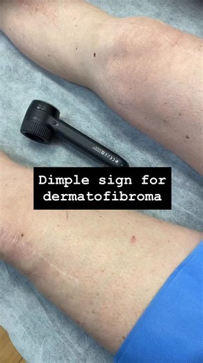 Dr John O’Bryen | Specialist GP on Instagram: "This lesion featured in yesterday’s post. The dimple sign helps confirm dermatofibroma but does NOT exclude malignancy. #dermoscopy #skincancer #skincancerdoctor #buderim #sunshinecoast #melanoma #basalcellcarcinoma #doctor #skincheck #squamouscellcarcinoma #actinickeratosis #mole #dermatoscope #sunspot #solarkeratosis"