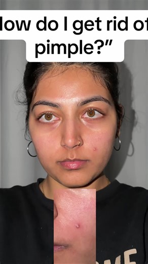 The Best Ingredient for Treating Active Pimples