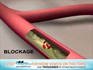 Effects of High Blood Pressure